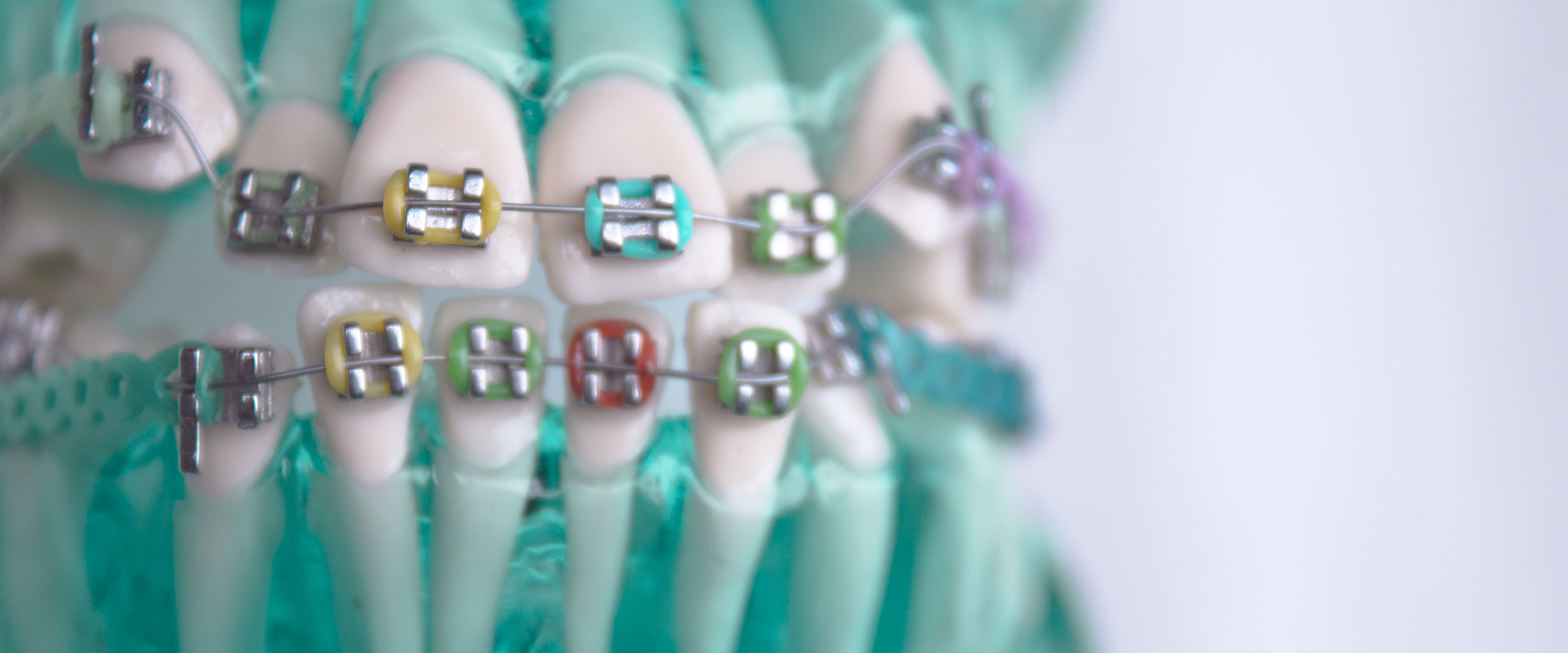 Dental Braces 