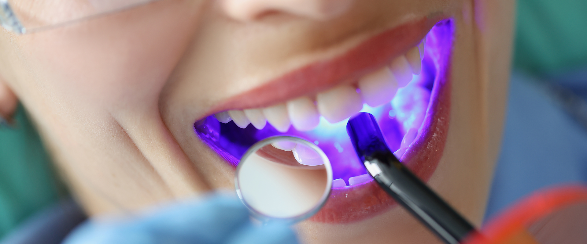 Teeth Bleaching 
