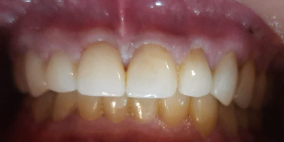teeth-after-1 