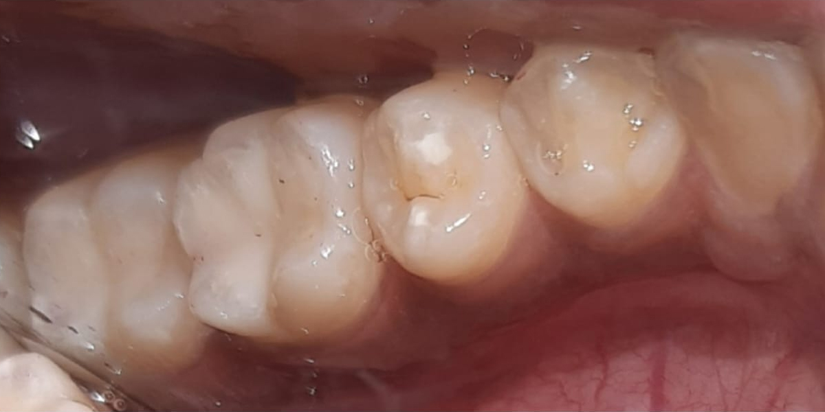 teeth-after 