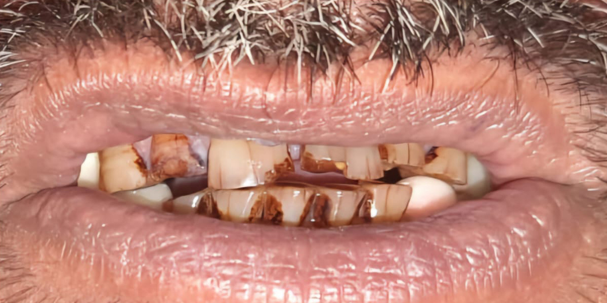 teeth-before-1 