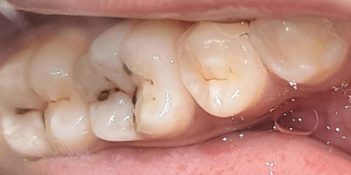 teeth-before 